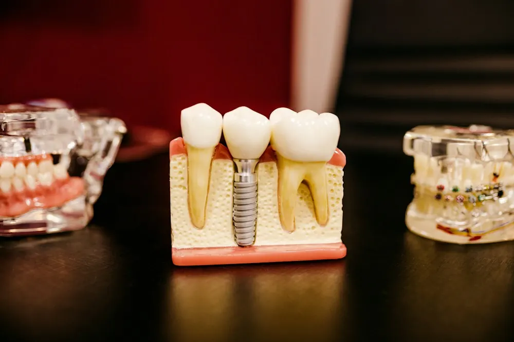 Model zubnog implantata